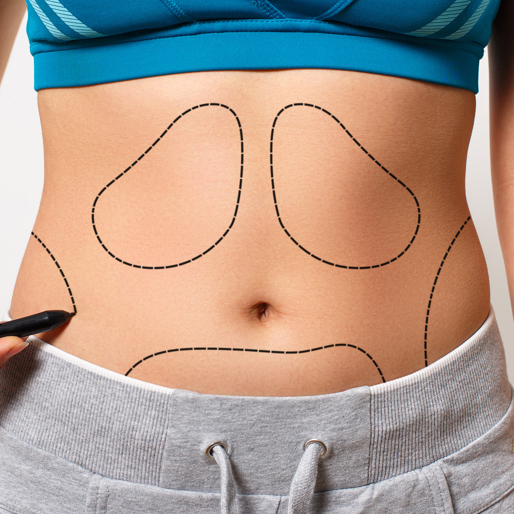 Karın Germe Ameliyatı