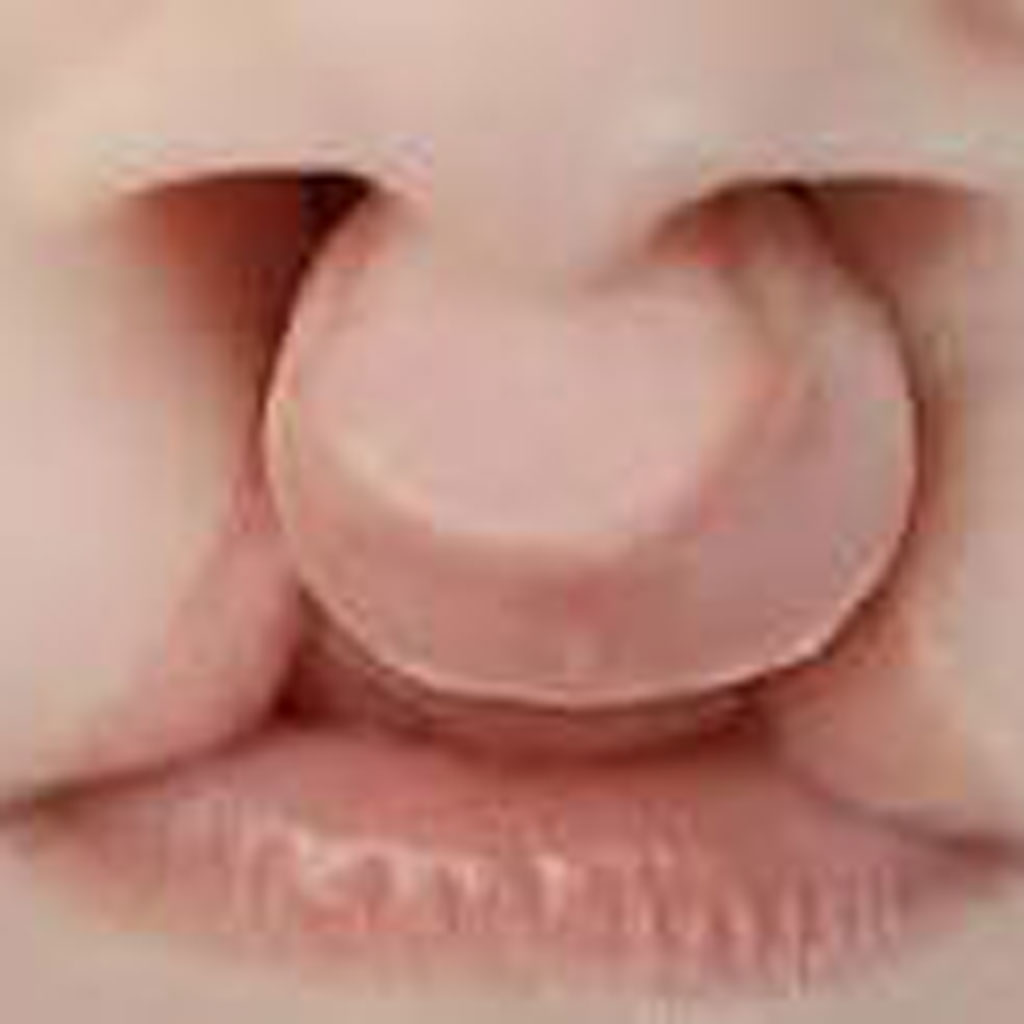 Dudak ve Damak Yarığı